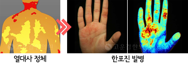 한포진 피부진료-콩닥콩닥 고운결한의원 일산점